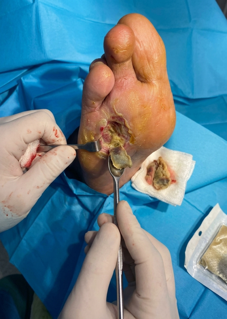 Our Services diabetic foot surgery